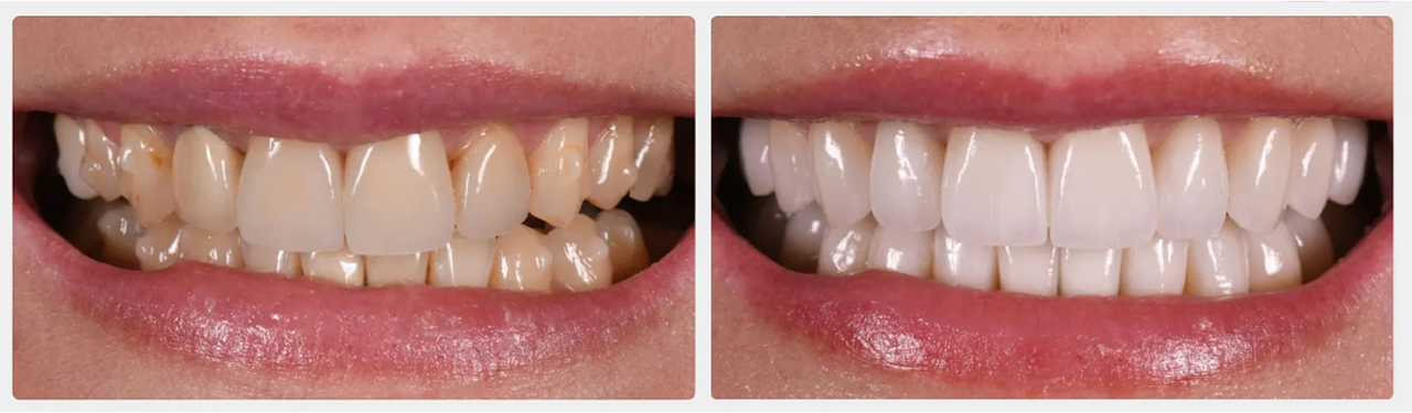Dental treatment slide showing patient results at Istanbul clinic