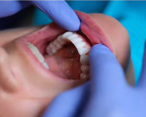 Aesthetic dentistry and porcelain veneers at dental clinic in Istanbul Turkey