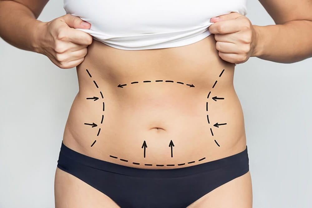 Liposuction Surgery SanteClinicTurkey
