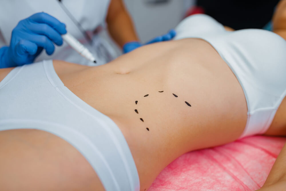 Tummy Tuck Surgery SanteClinicTurkey