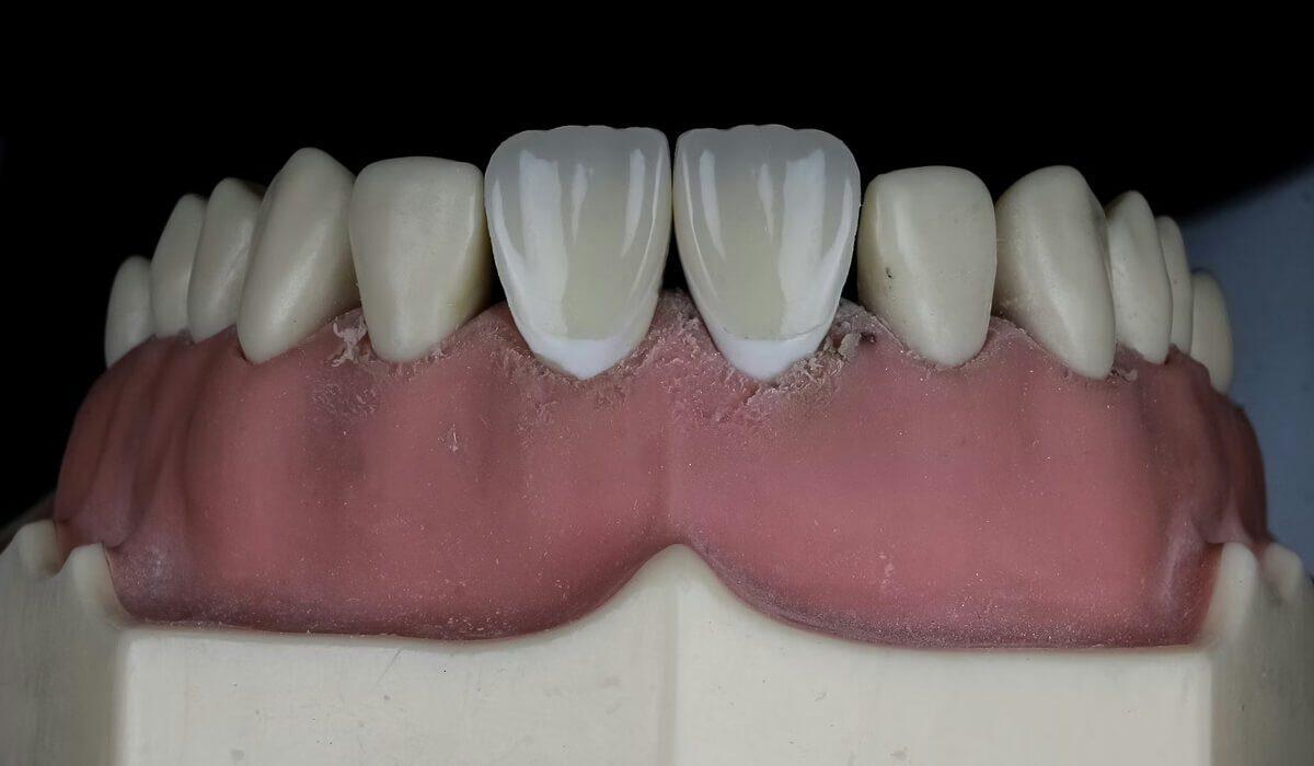 виниры E-max на зубах пациента клиники в Турции