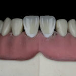 виниры E-max на зубах пациента клиники в Турции