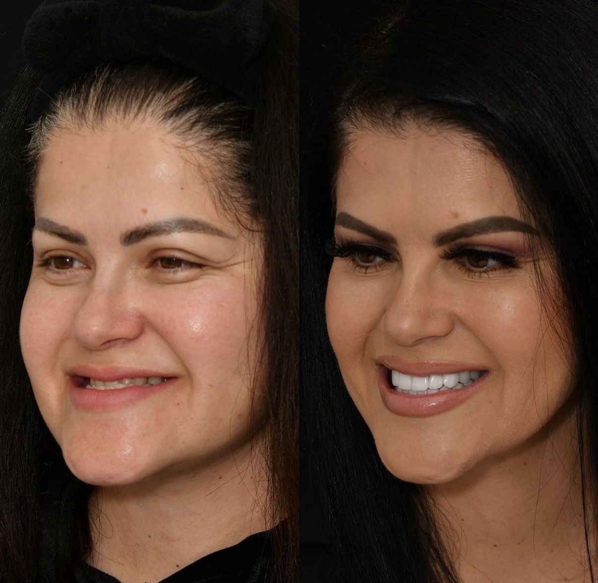 Виниры до и после - улыбка пациентки 1