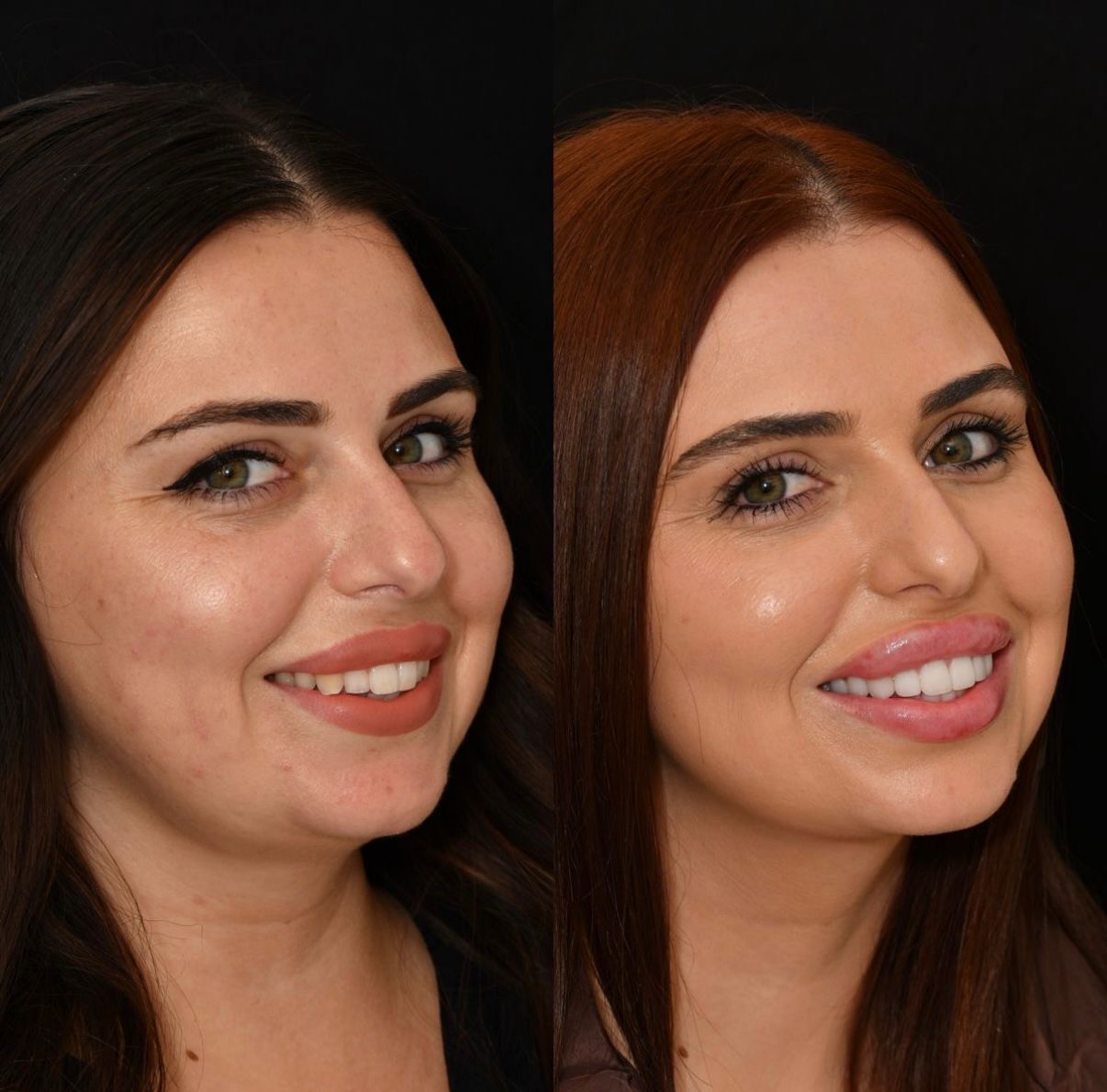 Виниры до и после - улыбка пациентки 2