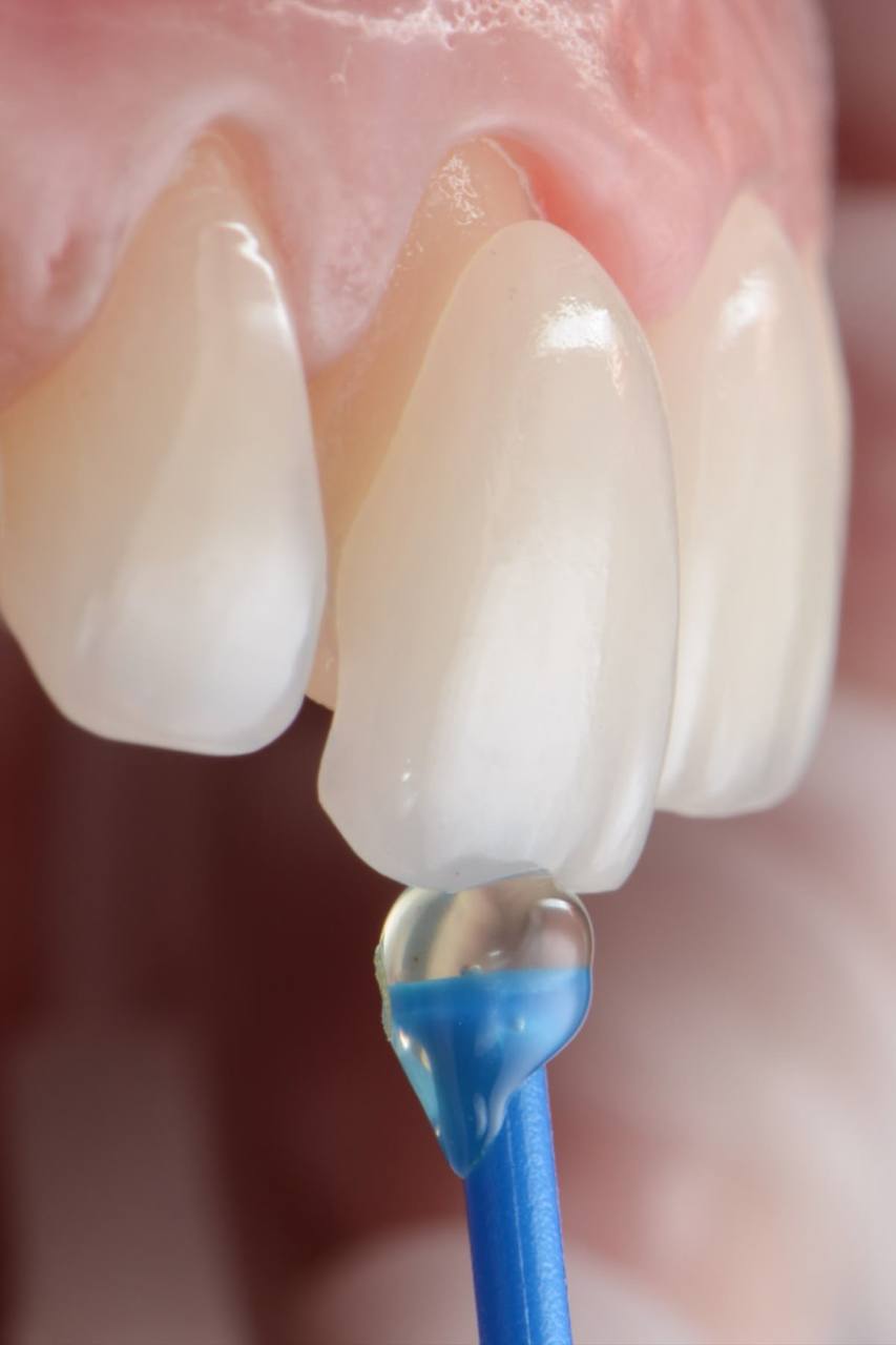 Виниры E-max бондинг процесс